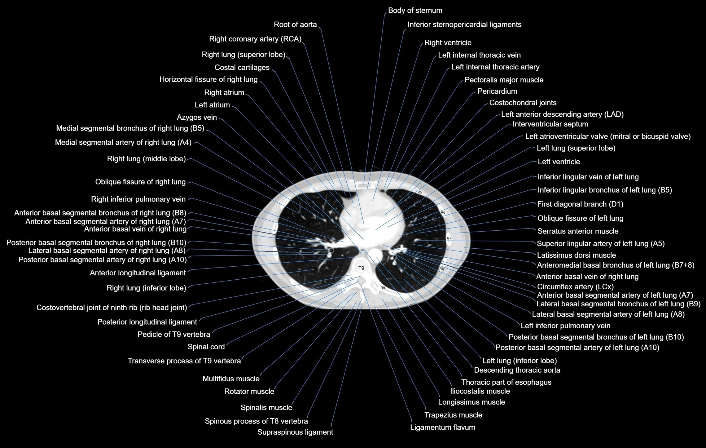 CT chest (thorax) lung window window labelled axial cross sectional anatomy radiology image-00075.webp